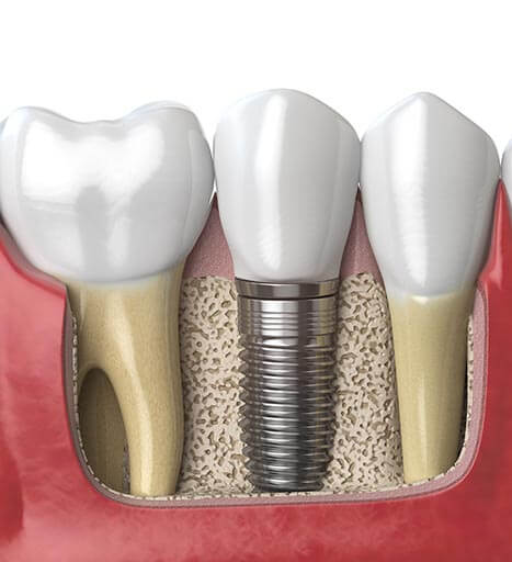 dental implants in New Smyrna Beach